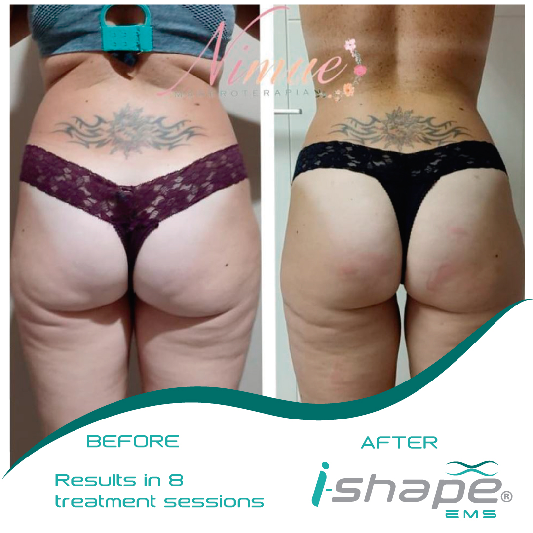 Resultado i-Shape antes y después