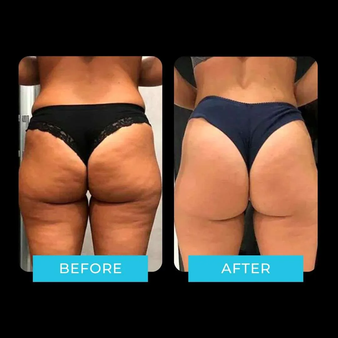 Antes y después i-Motion